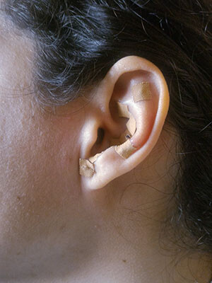 Tratamiento mediante auriculoterapia
