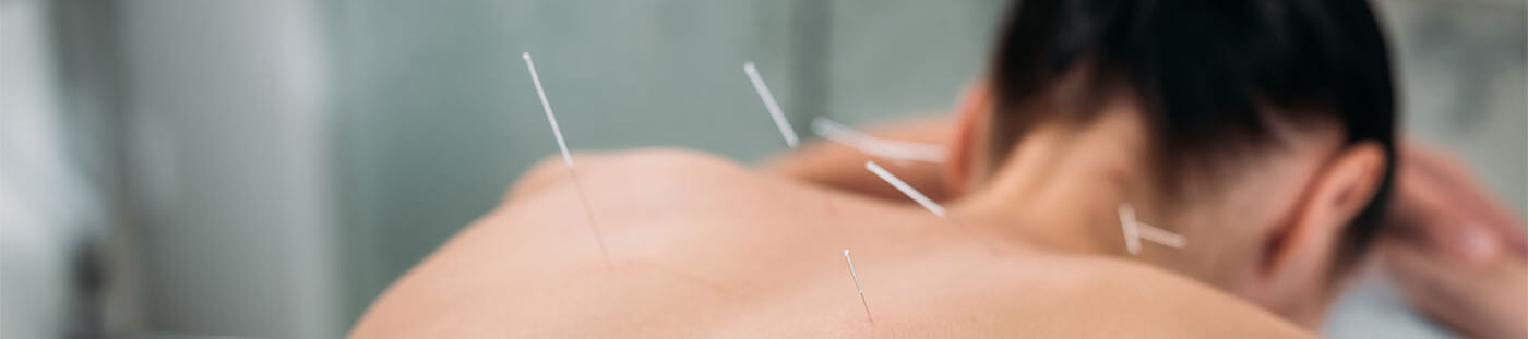 Beneficios de la acupuntura para adelgazar