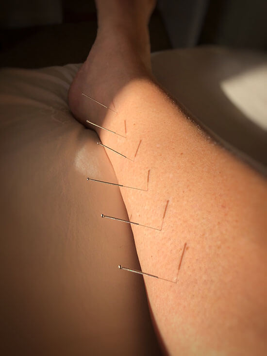 Beneficios de la acupuntura para el dolor